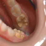 Enamel Defects (Chalky Teeth)