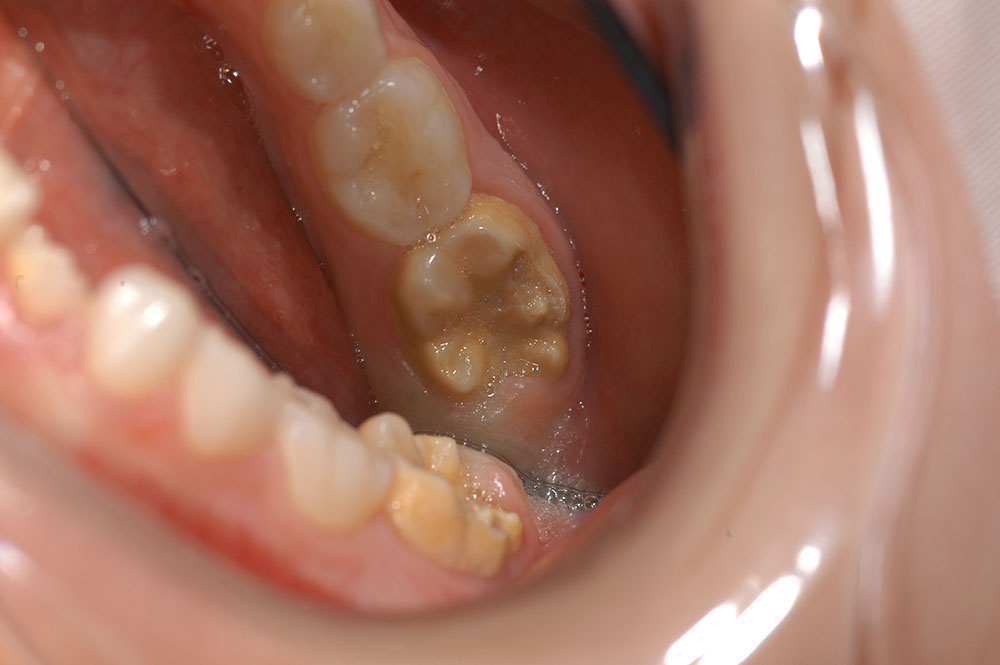 Enamel Defects (Chalky Teeth)